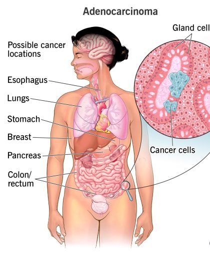 23180-carcinoma